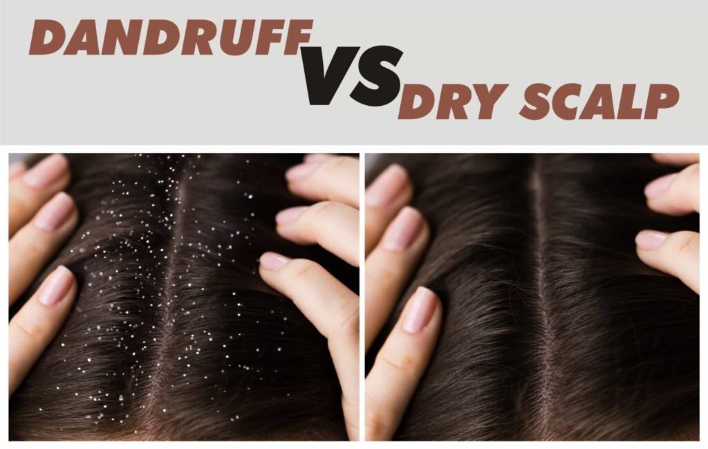 Differences between Dandruff and dry scalp [Explained] - Medical Darpan