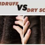 dandruff vs dry scalp