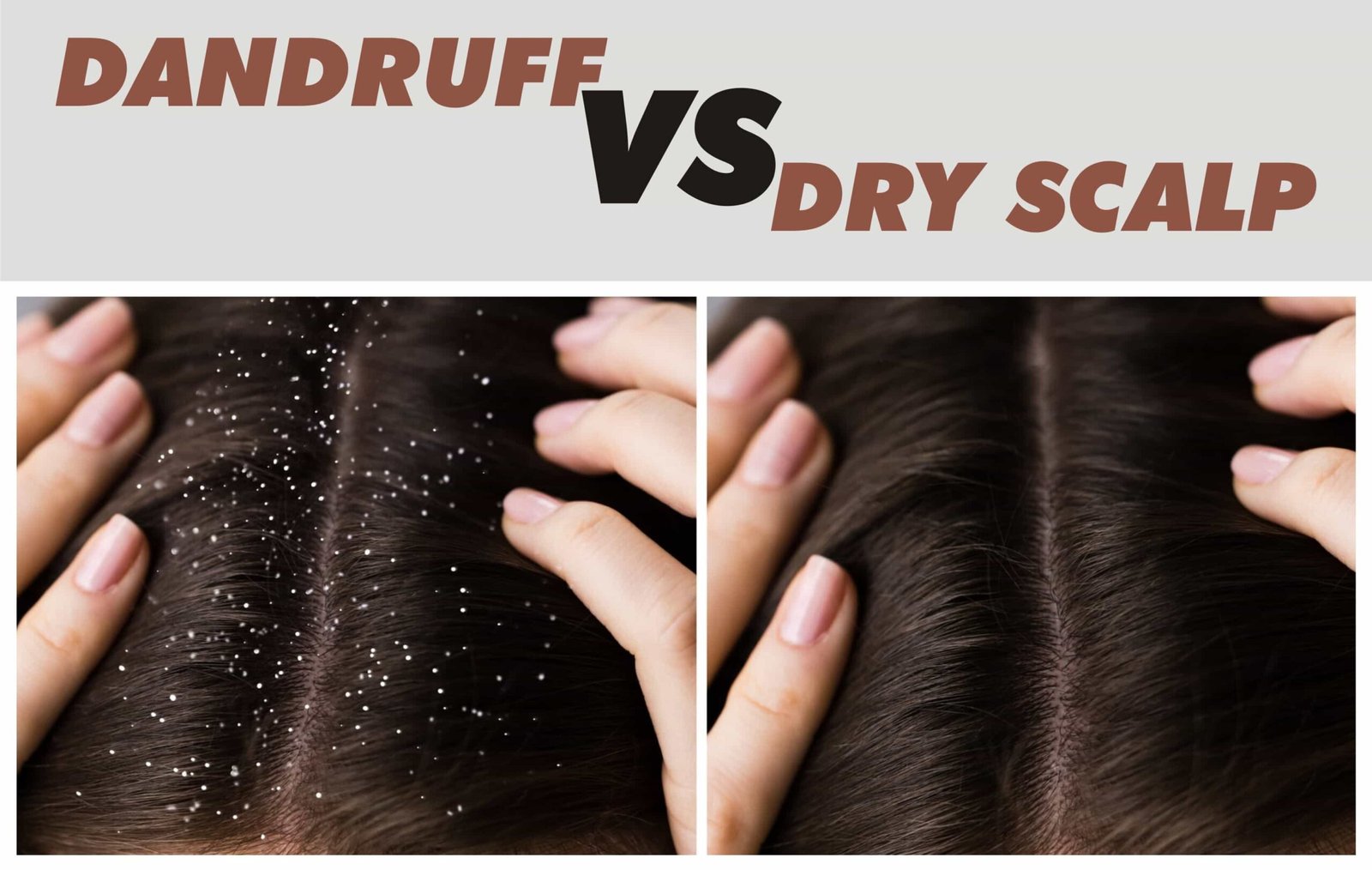 dandruff vs dry scalp