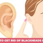 how to get rid of blackheads in ear-min