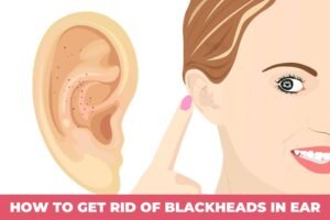 how to get rid of blackheads in ear-min