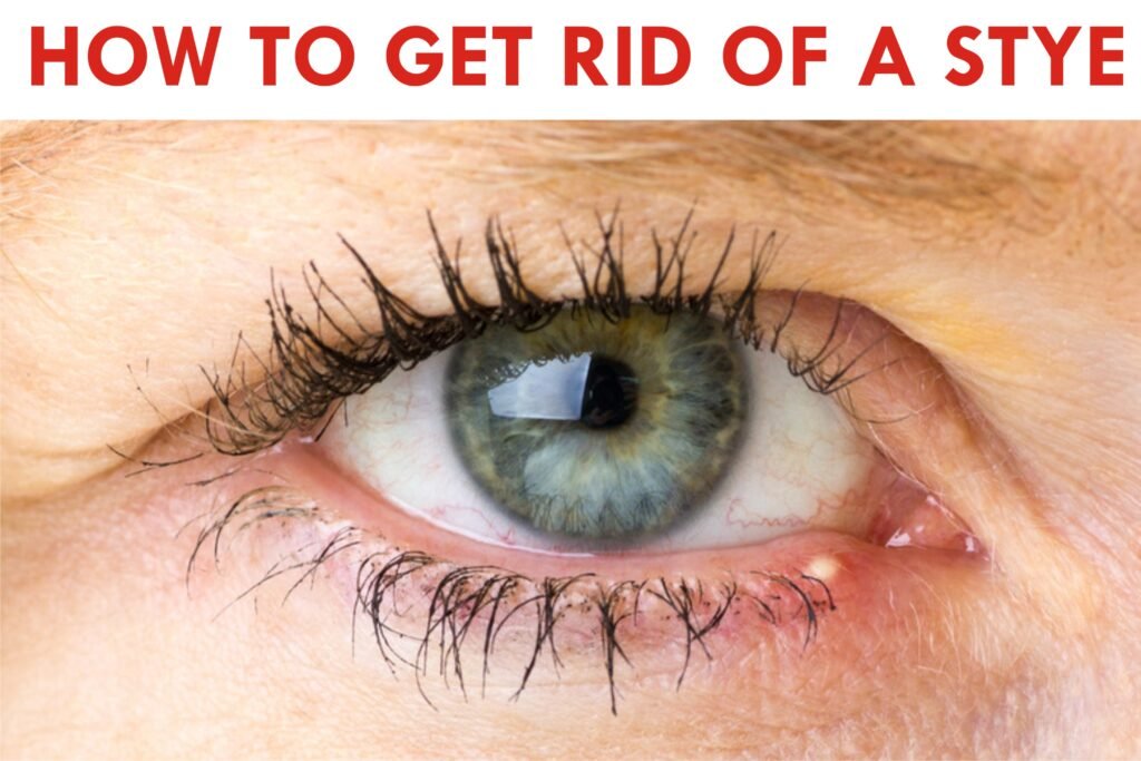 How to get rid of a stye