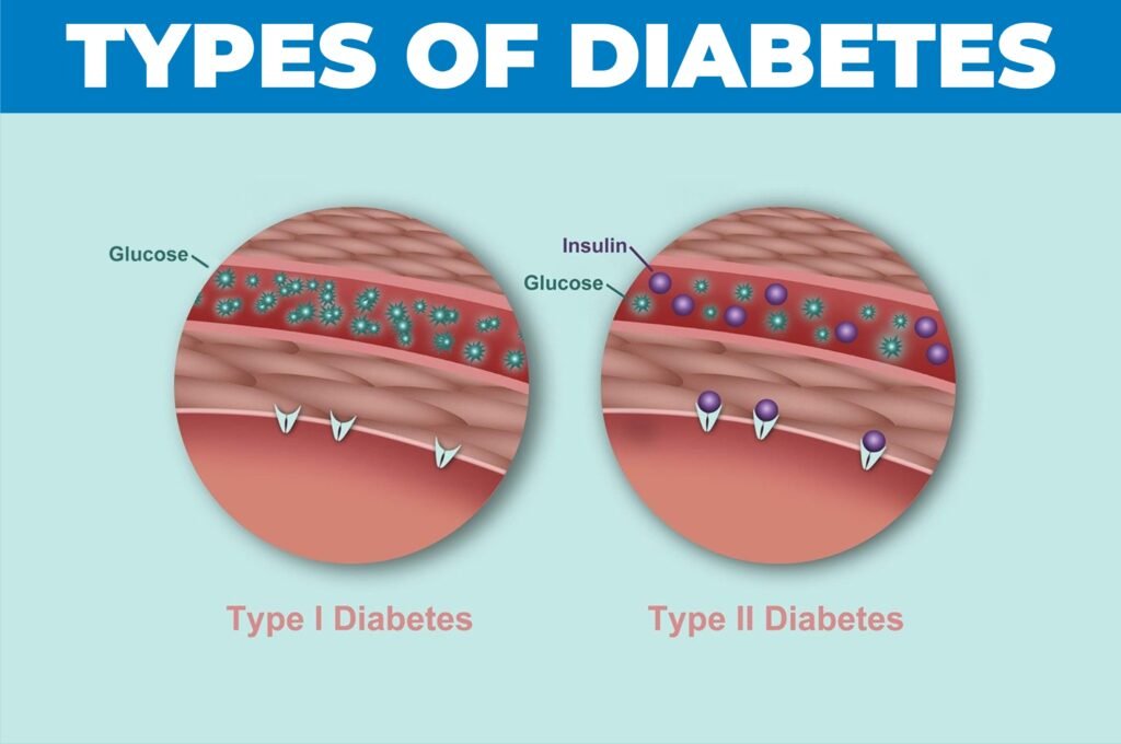 different types of diabetes
