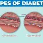 different types of diabetes