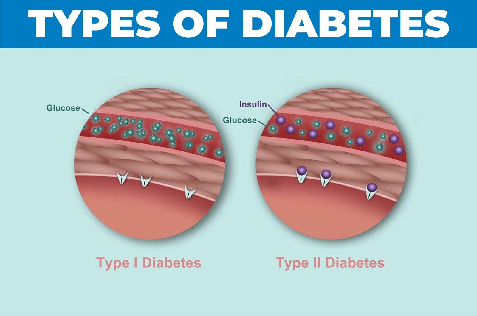 different types of diabetes